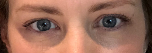 After Image: Lower Lid Blepharoplasty with Facial Rejuvenation - front