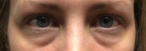Before Image: Lower Lid Blepharoplasty with Facial Rejuvenation - front