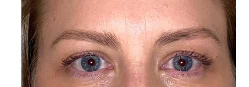 Botulinum eyebrow lift with rejuvenation