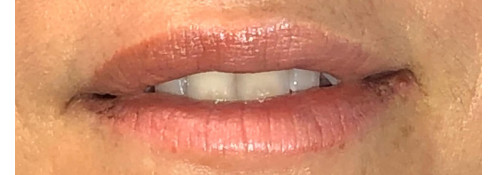 Lip filler and melolabial crease filler