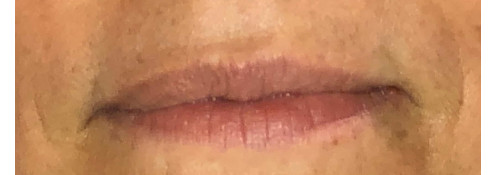 Lip filler and melolabial crease filler