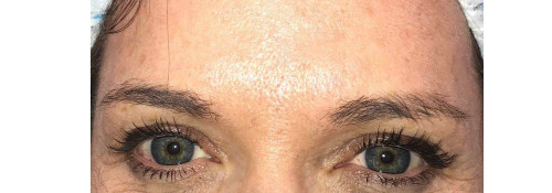 Xeomin injection chemical Browpexy with crows feet and forehead wrinkle treatment