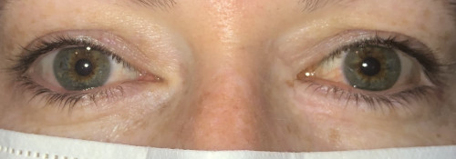Medial Canthal, Lower Eyelid, and Anterior Orbital Reconstruction