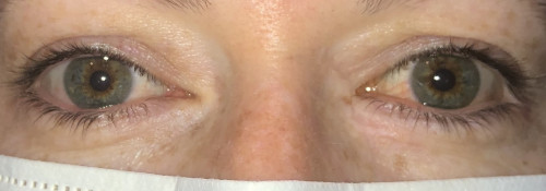 After Image: Medial Canthal, Lower Eyelid, and Anterior Orbital Reconstruction - front