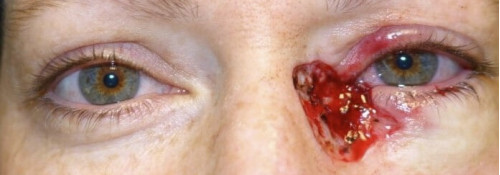 Before Image: Medial Canthal, Lower Eyelid, and Anterior Orbital Reconstruction - front
