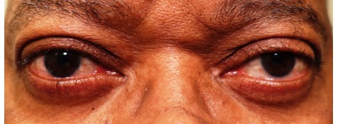 After Image: Ptosis Surgery Without Skin Removal - front