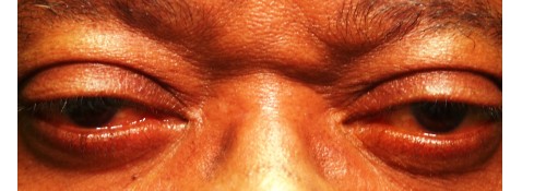 Before Image: Ptosis Surgery Without Skin Removal - front