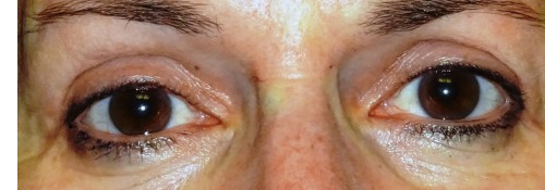 After Image: Assymetric Ptosis With Dermatochalasis Surgery - front