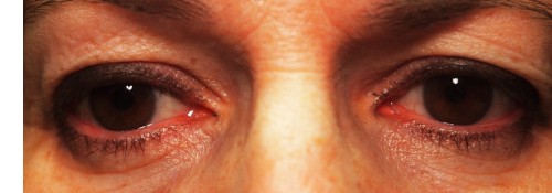 Before Image: Assymetric Ptosis With Dermatochalasis Surgery - front