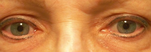 After Image: Mechanical Ptosis Surgery - front