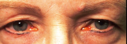 Before Image: Mechanical Ptosis Surgery - front