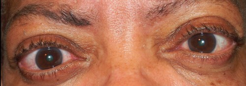 After Image: Fat & Bone Decompressions for Thyroid Eye Disease - front