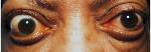 Before Image: Fat & Bone Decompressions for Thyroid Eye Disease - front