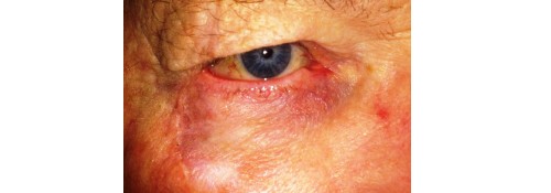 After Image: Lateral Lower Lid MOHS Reconstruction - front