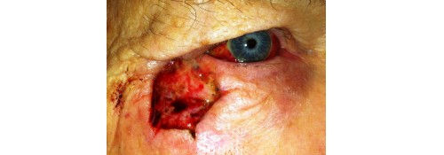Before Image: Lateral Lower Lid MOHS Reconstruction - front