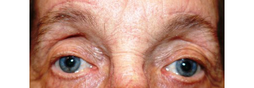 After Image: Direct Brow Lift - front