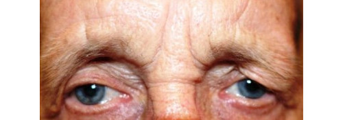Before Image: Direct Brow Lift - front