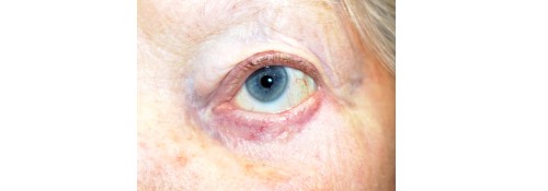 After Image: Left Lower Eyelid Margin Reconstruction - front