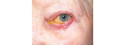 Before Image: Left Lower Eyelid Margin Reconstruction - front
