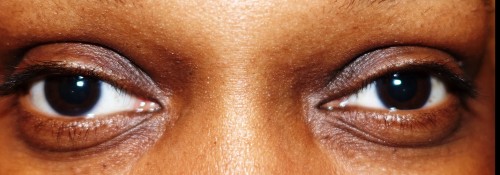 Upper Eyelid Recession