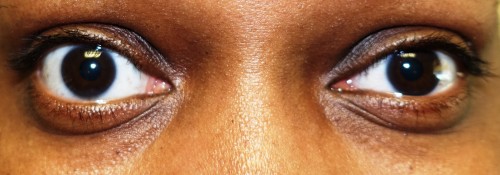 Upper Eyelid Recession