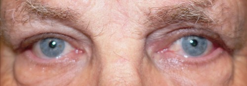 After Image: Ptosis repair, blepharoplasty, and ectropion repair - front