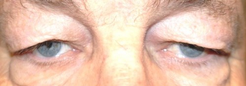 Before Image: Ptosis repair, blepharoplasty, and ectropion repair - front