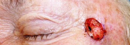 Before Image: Left Lateral Canthal/Temporal MOHS Reconstruction - front