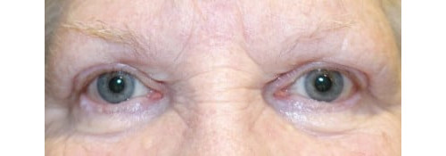 After Image: Internal Browpexy - front